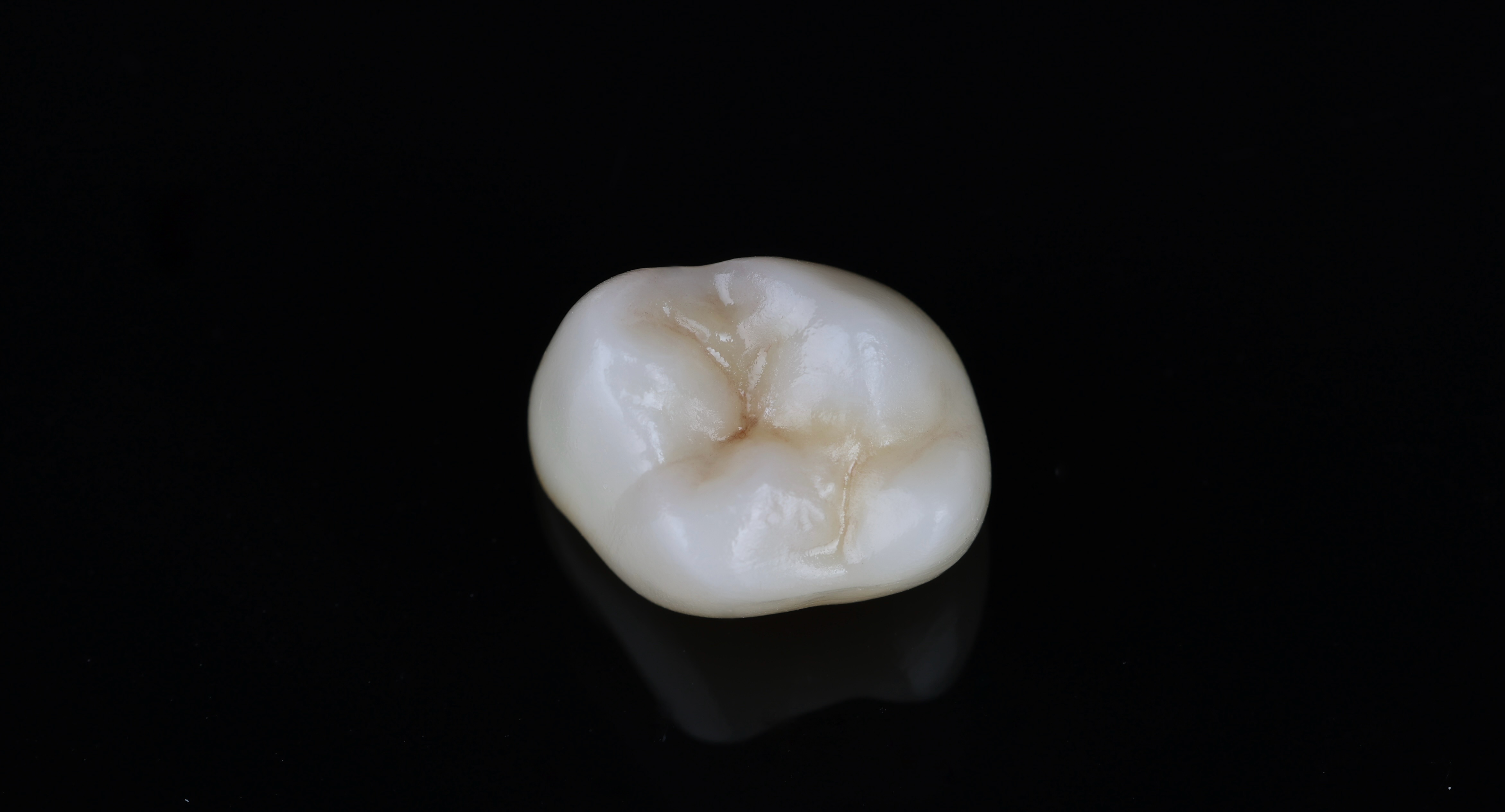 Aesthetic zirconia crown — occlusal detail, Epic Dental Creations